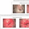 What could be the causes of cervical erosion in nulliparous: diagnosis of the disease