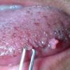What do papillomas look like in a person's mouth?