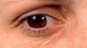 Zúzódások a szem alatt: honnan származnak és hogyan lehet megszabadulni tőlük - Sárga zúzódások