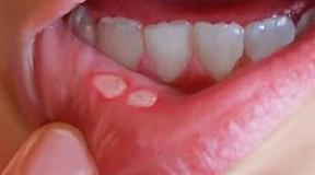 Stomatitis: Effective treatment in adults, shape of stomatitis