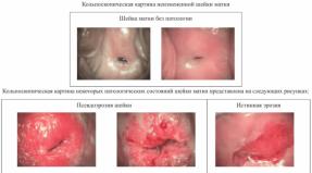 What could be the causes of cervical erosion in nulliparous: diagnosis of the disease