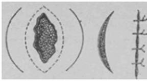 Plastic surgery with a skin flap on the feeding pedicle Non-free plastic